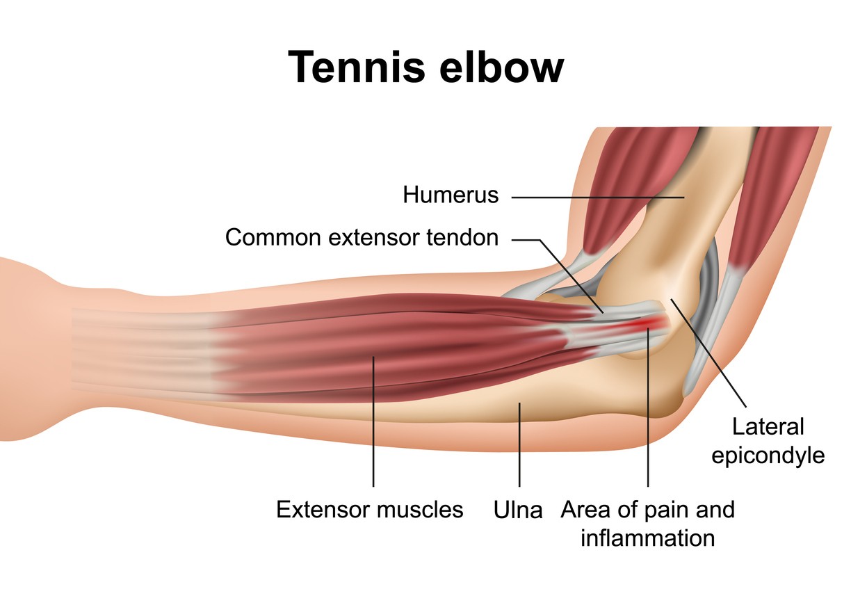 Got bad tennis elbow? See if can a chiropractor help with tennis elbow and get you better faster.